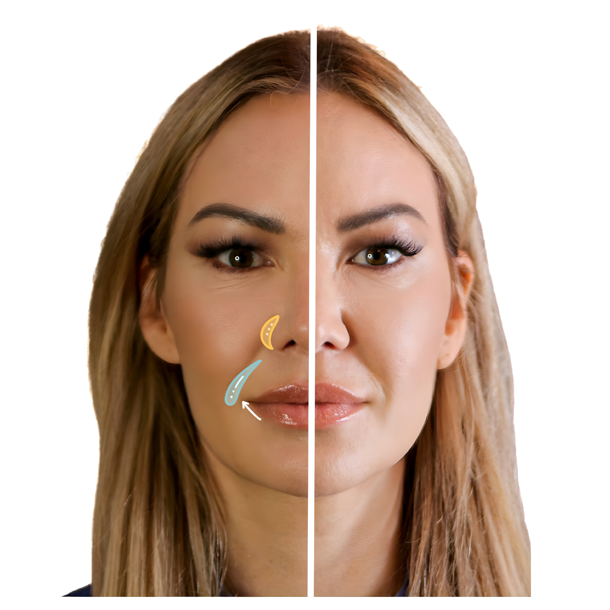 Lower Face Filler